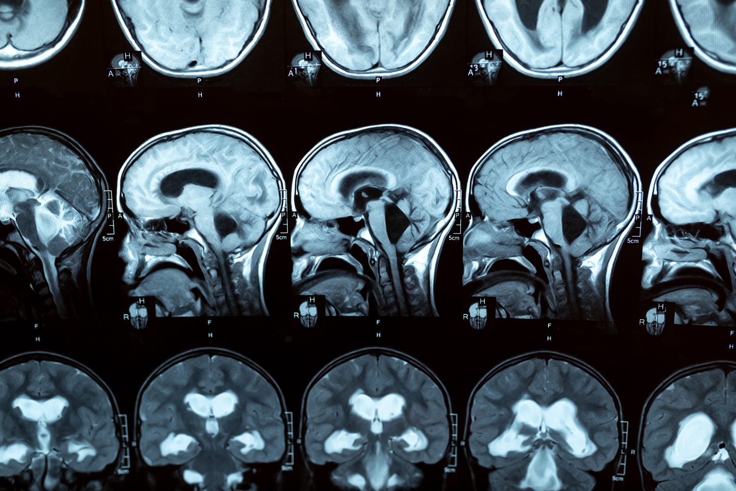 Exploring the Connection Between Incontinence and Dementia: Understanding, Managing, and Seeking Relief